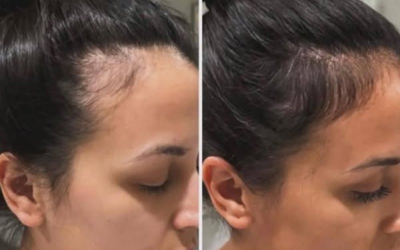 Ankara Saç Çoğaltma | Ameliyatsız Saç Güçlendirme Uygulamaları