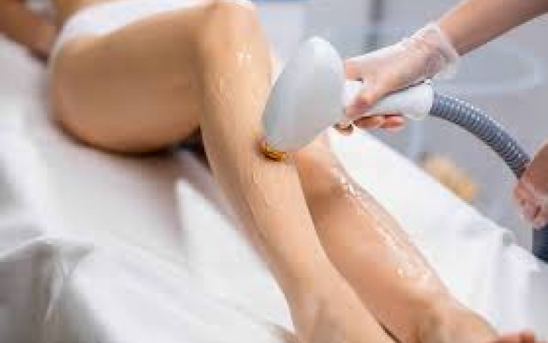 Ankara  Lazer Epilasyon | Kalıcı ve Güvenli Çözümler